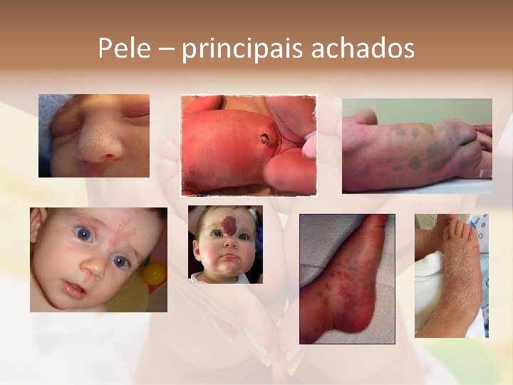 Pele – principais achados 