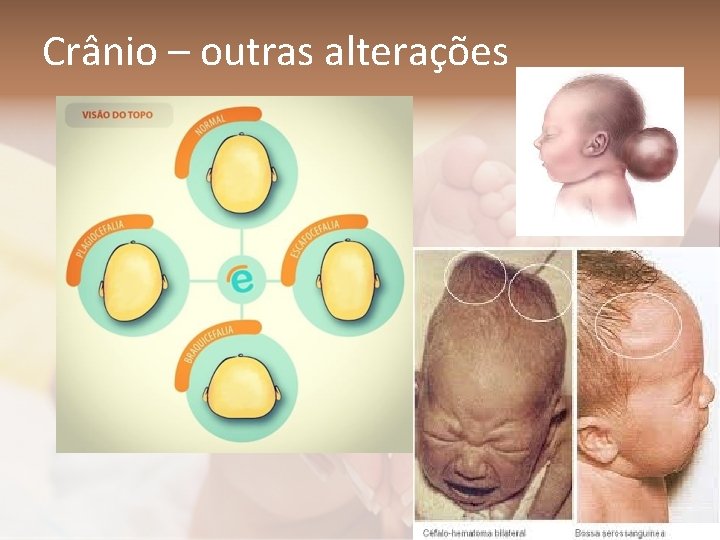 Crânio – outras alterações 
