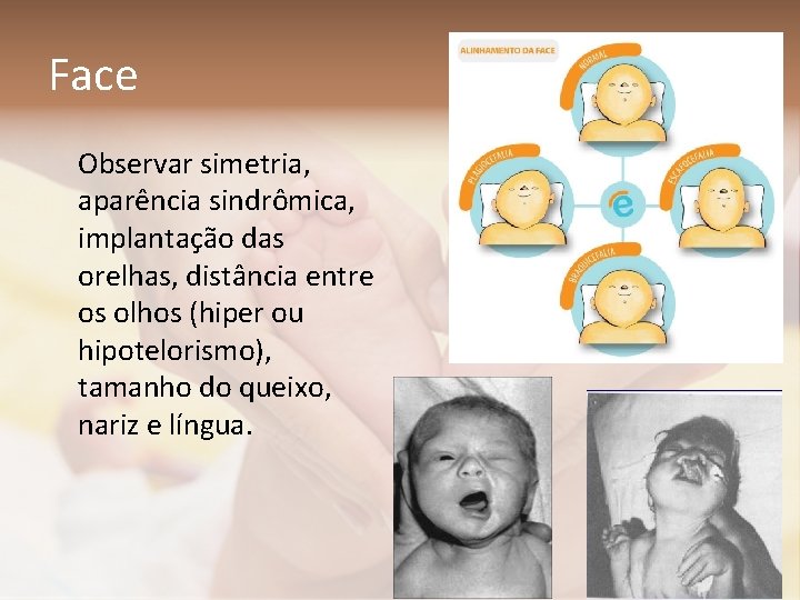 Face Observar simetria, aparência sindrômica, implantação das orelhas, distância entre os olhos (hiper ou