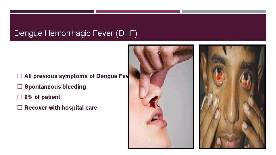 Dengue Hemorrhagic Fever (DHF) � All previous symptoms of Dengue Fever � Spontaneous bleeding