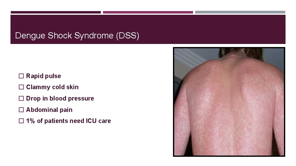 Dengue Shock Syndrome (DSS) � Rapid pulse � Clammy cold skin � Drop in