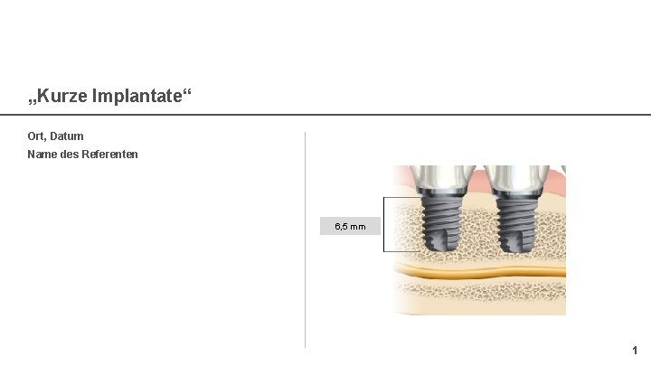 „Kurze Implantate“ Ort, Datum Name des Referenten 6, 5 mm 1 