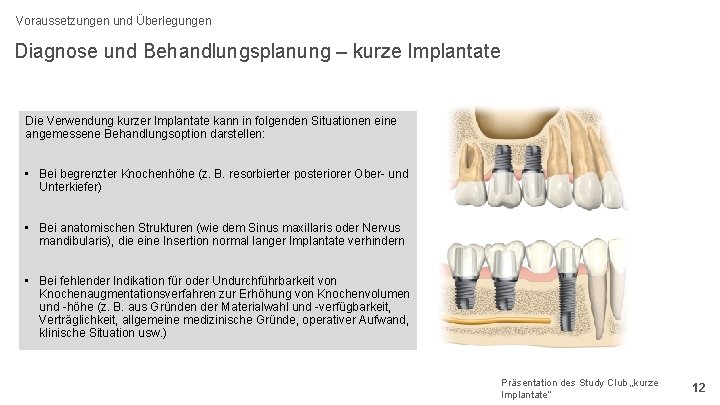 Voraussetzungen und Überlegungen Diagnose und Behandlungsplanung – kurze Implantate Die Verwendung kurzer Implantate kann