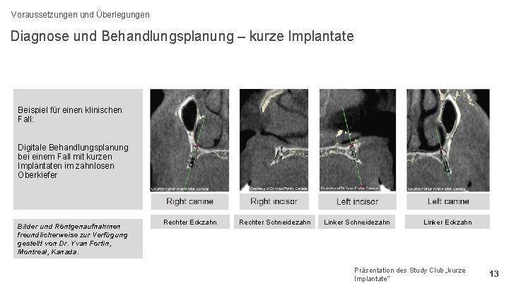 Voraussetzungen und Überlegungen Diagnose und Behandlungsplanung – kurze Implantate Beispiel für einen klinischen Fall: