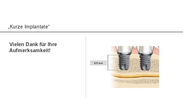 „Kurze Implantate“ Vielen Dank für Ihre Aufmerksamkeit! 6, 5 mm 