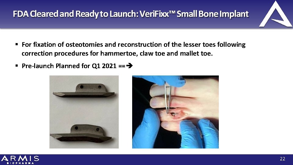 FDA Cleared and Ready to Launch: Veri. Fixx™ Small Bone Implant For fixation of
