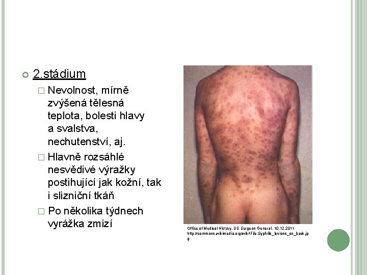 2. stádium � Nevolnost, mírně zvýšená tělesná teplota, bolesti hlavy a svalstva, nechutenství, 2. stádium � Nevolnost, mírně zvýšená tělesná teplota, bolesti hlavy a svalstva, nechutenství,