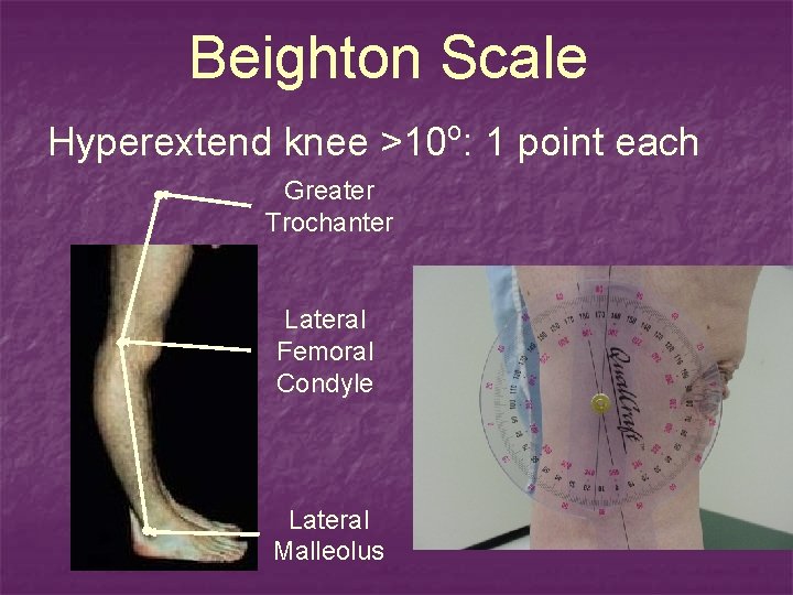 Beighton Scale o Hyperextend knee >10 : 1 point each Greater Trochanter Lateral Femoral