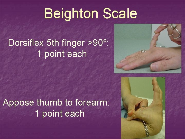 Beighton Scale o Dorsiflex 5 th finger >90 : 1 point each Appose thumb