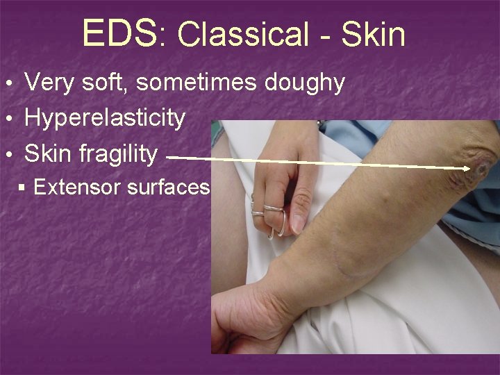 EDS: Classical - Skin • Very soft, sometimes doughy • Hyperelasticity • Skin fragility