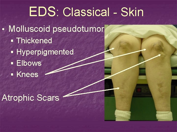 EDS: Classical - Skin • Molluscoid pseudotumor § Thickened § Hyperpigmented § Elbows §