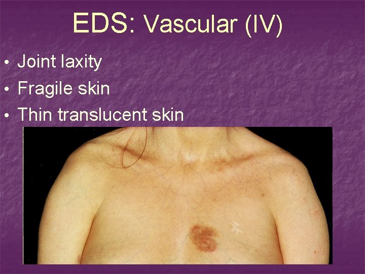 EDS: Vascular (IV) • Joint laxity • Fragile skin • Thin translucent skin 