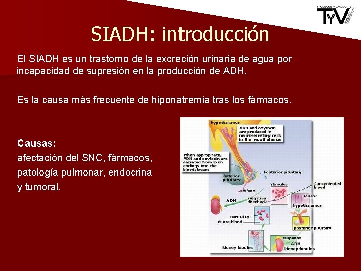 SIADH: introducción El SIADH es un trastorno de la excreción urinaria de agua por