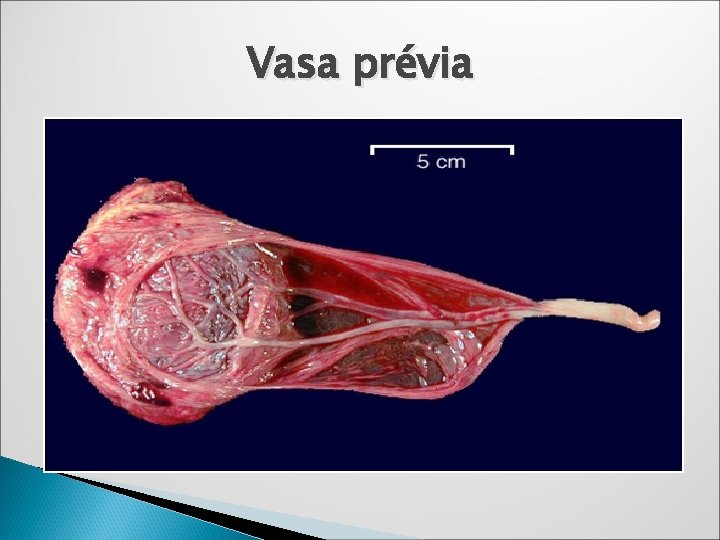 Vasa prévia Vasa prévia
