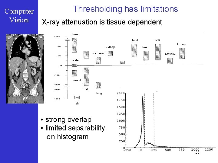 Computer Vision Thresholding has limitations X-ray attenuation is tissue dependent bone liver blood kidney