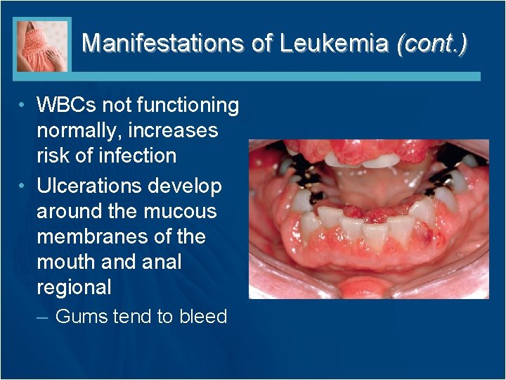 Manifestations of Leukemia (cont. ) • WBCs not functioning normally, increases risk of infection Manifestations of Leukemia (cont. ) • WBCs not functioning normally, increases risk of infection