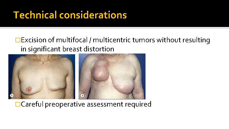 Technical considerations �Excision of multifocal / multicentric tumors without resulting in significant breast distortion