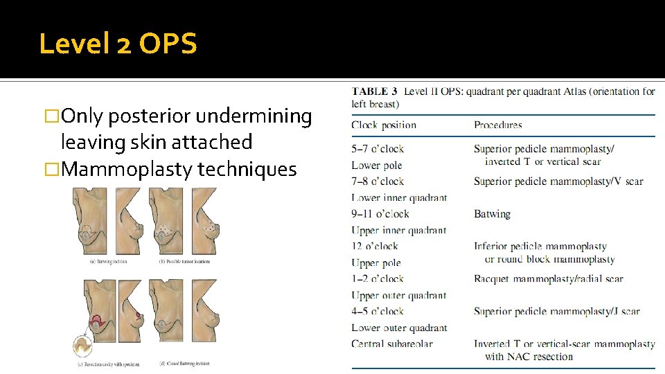 Level 2 OPS �Only posterior undermining leaving skin attached �Mammoplasty techniques 