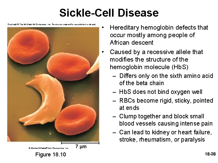 Sickle-Cell Disease Copyright © The Mc. Graw-Hill Companies, Inc. Permission required for reproduction or