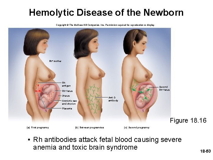 Hemolytic Disease of the Newborn Copyright © The Mc. Graw-Hill Companies, Inc. Permission required