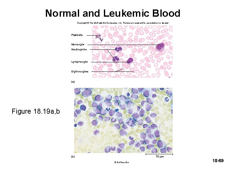 Normal and Leukemic Blood Copyright © The Mc. Graw-Hill Companies, Inc. Permission required for