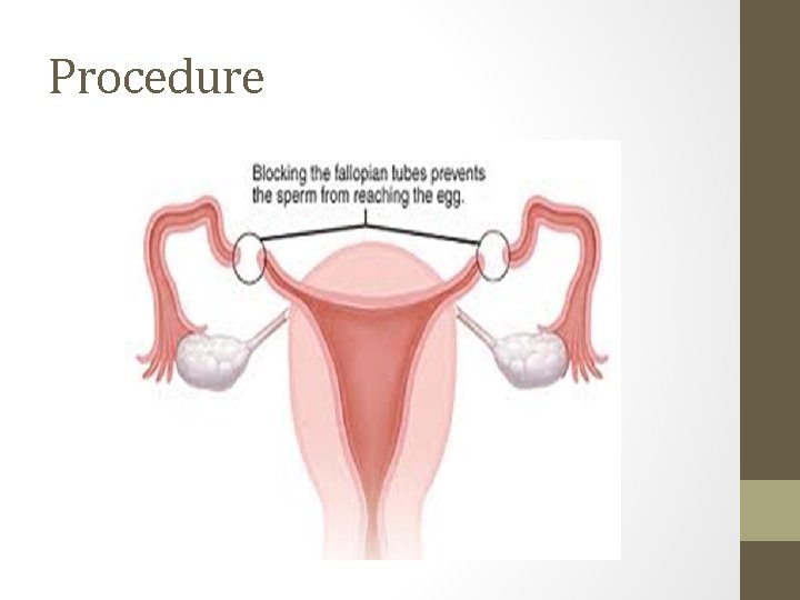 Procedure 
