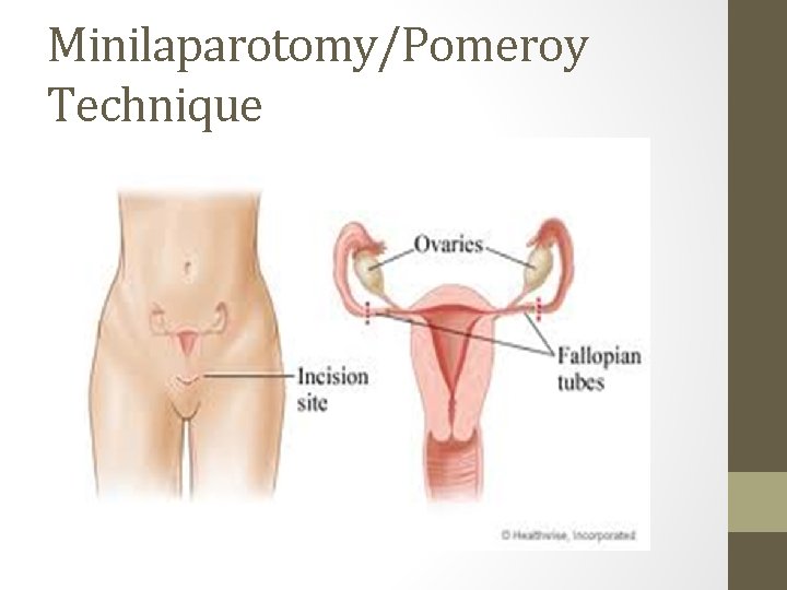 Minilaparotomy/Pomeroy Technique 
