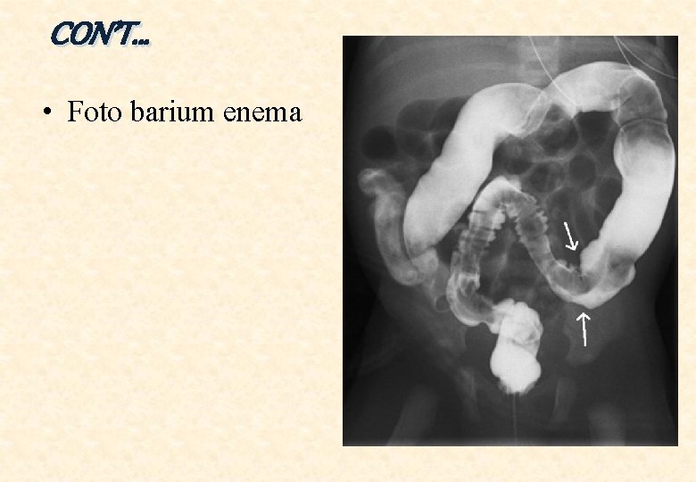 CON’T… • Foto barium enema 