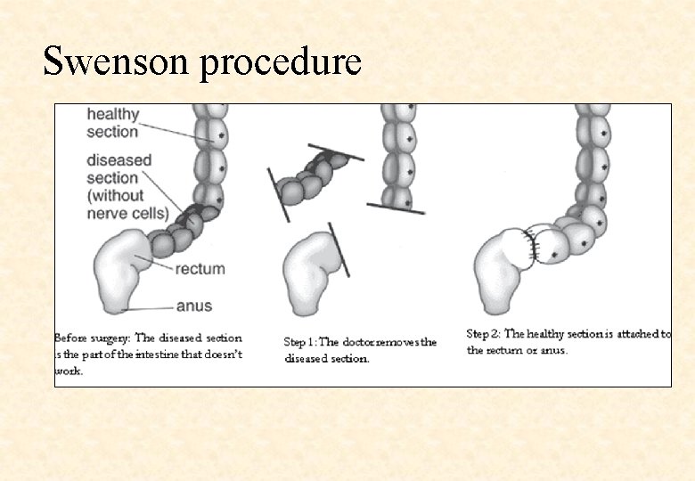 Swenson procedure 