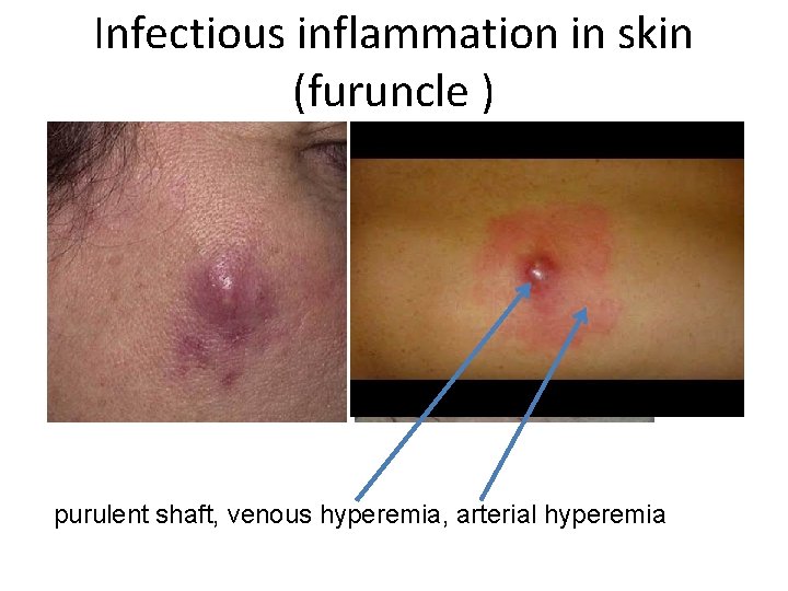 Infectious inflammation in skin (furuncle ) purulent shaft, venous hyperemia, arterial hyperemia 
