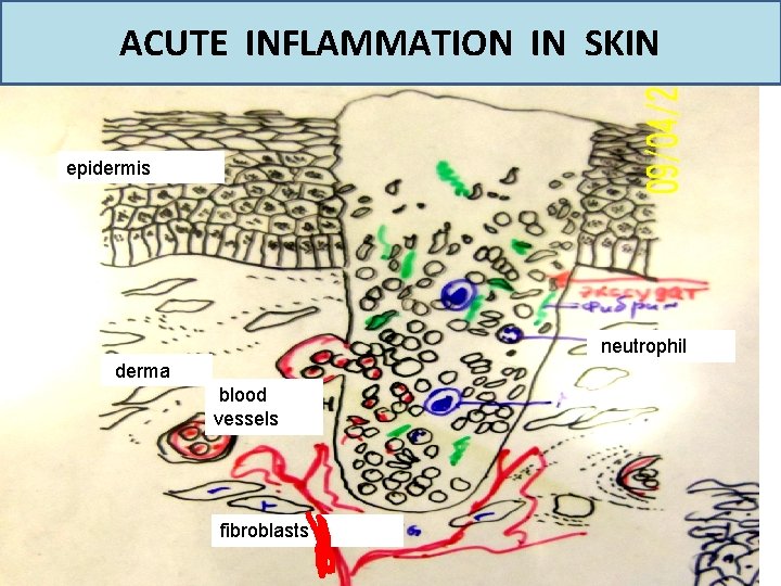 ACUTE INFLAMMATION IN SKIN epidermis neutrophil derma blood vessels fibroblasts 