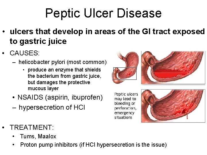 Peptic Ulcer Disease • ulcers that develop in areas of the GI tract exposed