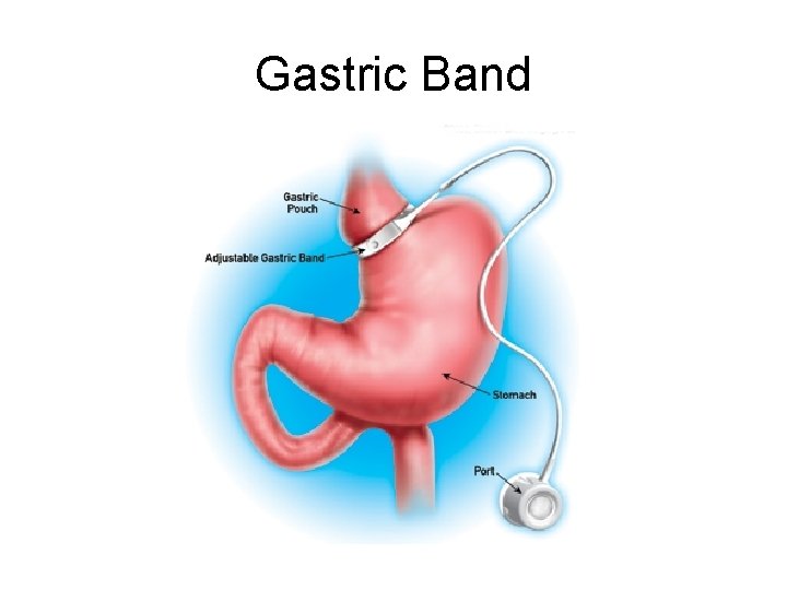 Gastric Band 