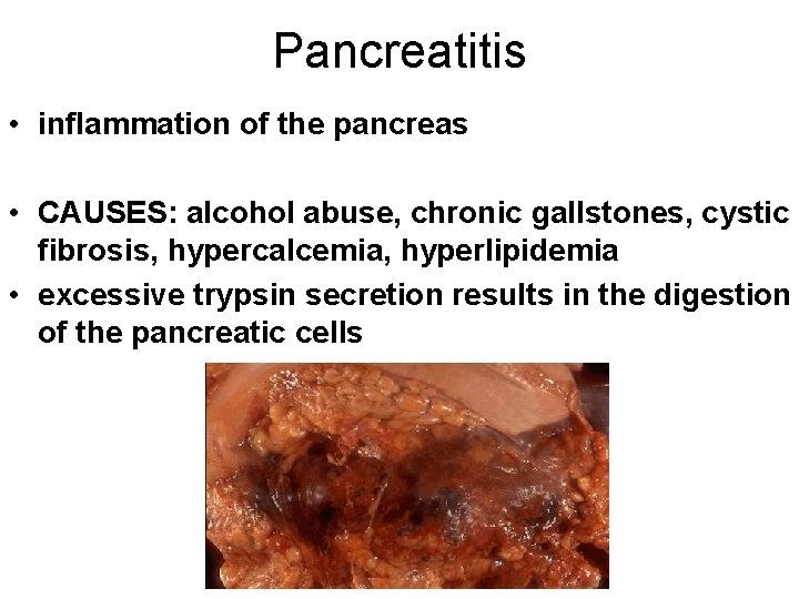 Pancreatitis • inflammation of the pancreas • CAUSES: alcohol abuse, chronic gallstones, cystic fibrosis,