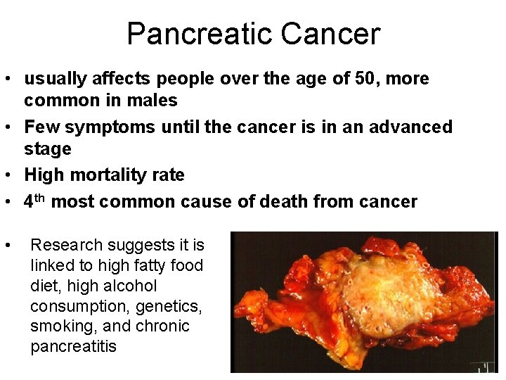 Pancreatic Cancer • usually affects people over the age of 50, more common in