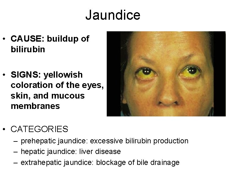 Jaundice • CAUSE: buildup of bilirubin • SIGNS: yellowish coloration of the eyes, skin,