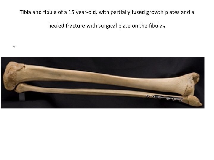 Tibia and fibula of a 15 year-old, with partially fused growth plates and a