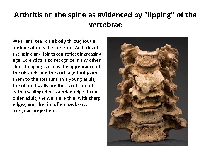 Arthritis on the spine as evidenced by "lipping" of the vertebrae Wear and tear