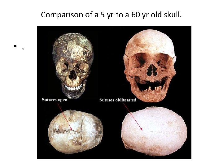 Comparison of a 5 yr to a 60 yr old skull. • . 