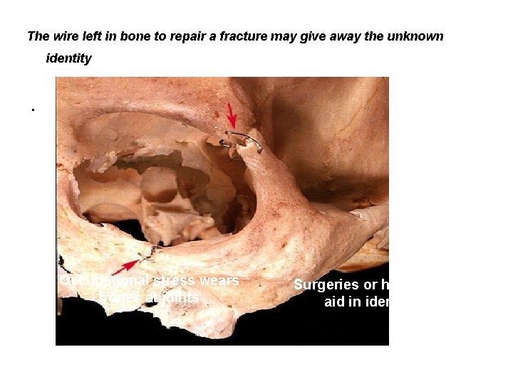 The wire left in bone to repair a fracture may give away the unknown