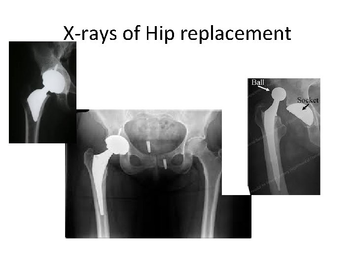 X-rays of Hip replacement • . 