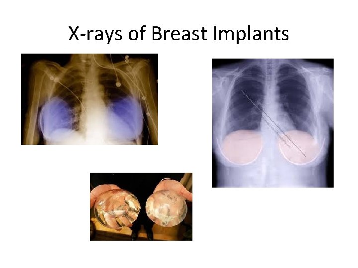 X-rays of Breast Implants • . 