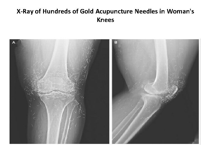 X-Ray of Hundreds of Gold Acupuncture Needles in Woman's Knees 