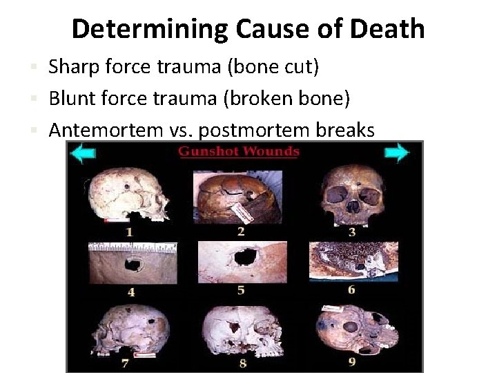 Determining Cause of Death Sharp force trauma (bone cut) § Blunt force trauma (broken