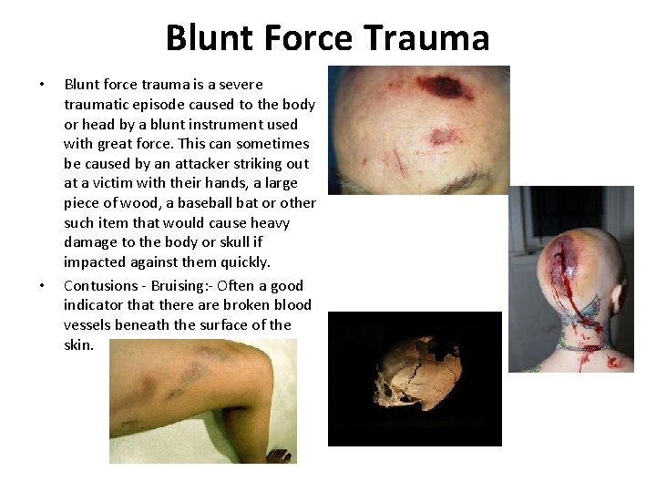 Blunt Force Trauma • • Blunt force trauma is a severe traumatic episode caused