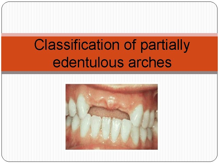 Classification of partially edentulous arches 