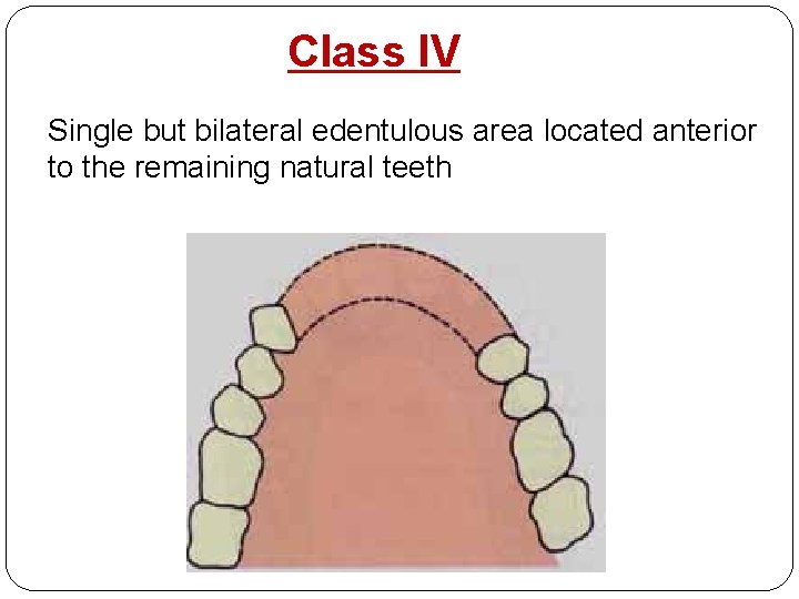 Class IV Single but bilateral edentulous area located anterior to the remaining natural teeth