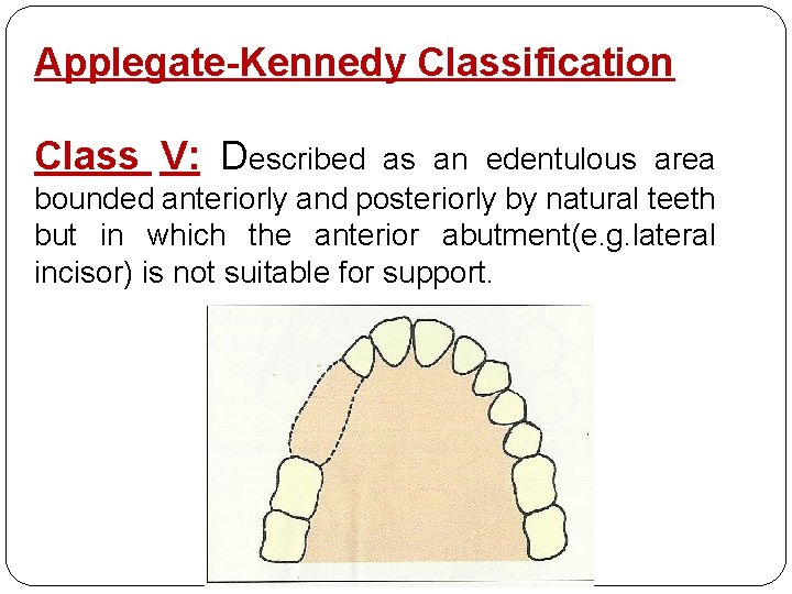 Applegate-Kennedy Classification Class V: Described as an edentulous area bounded anteriorly and posteriorly by