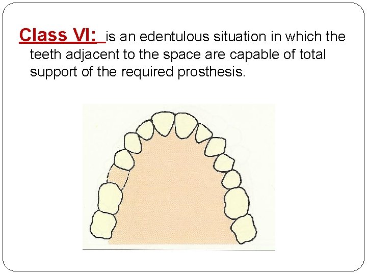 Class VI: is an edentulous situation in which the teeth adjacent to the space