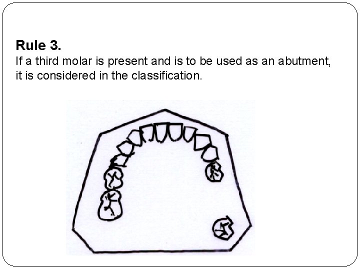 Rule 3. If a third molar is present and is to be used as
